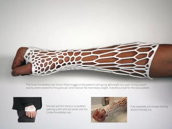Introducing Cortex - A Breathable, Recyclable 3D-Printed Arm Cast 2 cortex-1