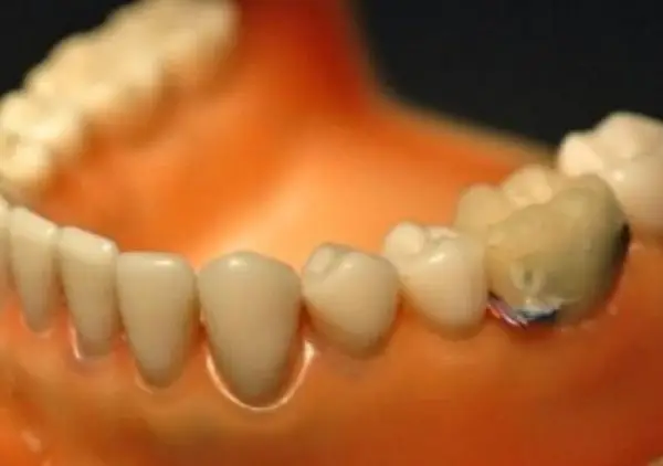 This Wi-Fi Tooth Sensor Shames You When Overeating or Smoking 2 toothsensor