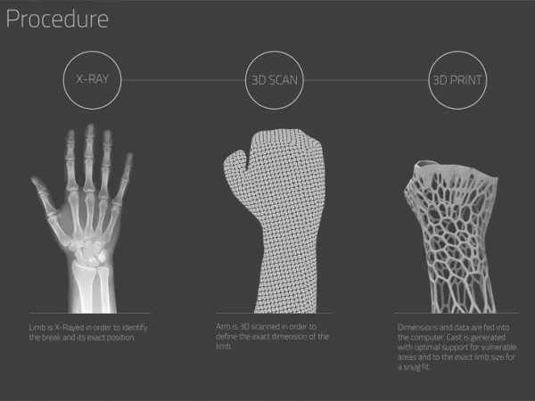 3dprintedcast1