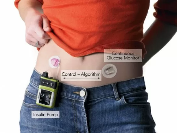 Medtronic MiniMed is a Wearable Artificial Pancreas 3 minimed2