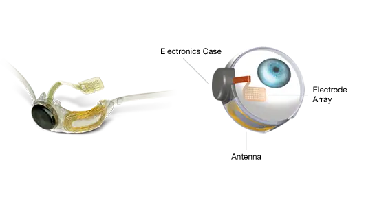Argus II Retinal Prosthesis System - The Bionic Eye 3 Argus1