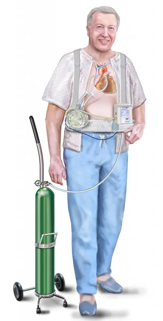 Artificial Lung for Lung Transplant Patients 3 Artificial Lung