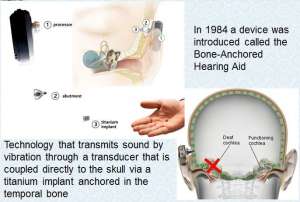 A bone-anchored hearing aid (BAHA) or bone-anchored ...