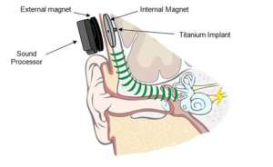 Bone Conduction Implant - Hearing Healthcare Professionals