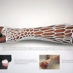 Introducing Cortex - A Breathable, Recyclable 3D-Printed Arm Cast 25