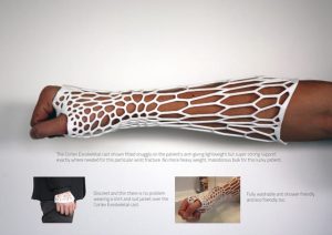 Introducing Cortex - A Breathable, Recyclable 3D-Printed Arm Cast 6