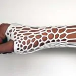 Cortex Cast - 3D Printing to Change How We Fix Broken Bones 25