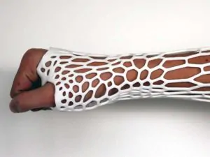 Cortex Cast - 3D Printing to Change How We Fix Broken Bones 16 Cortex Cast - 3D Printing to Change How We Fix Broken Bones 13