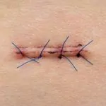 Smart stitches are equipped with sensors to help you heal in a jiffy 2