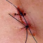 Smart stitches are equipped with sensors to help you heal in a jiffy 21