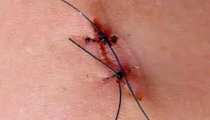 Smart stitches are equipped with sensors to help you heal in a jiffy 1