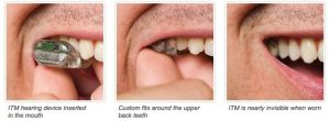 Sonitus Medical's SoundBite dental hearing aid receives European approval 11